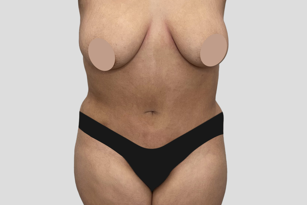 After-ABDOMINOPLASTIA