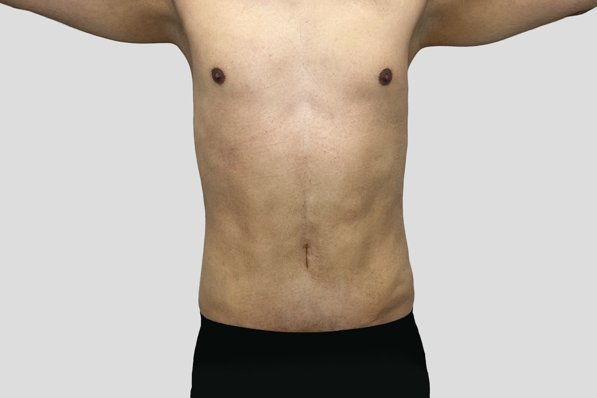 After-GINECOMASTECTOMÍA + LIPOSUCCIÓN DE ABDOMEN Y ESPALDA BAJA