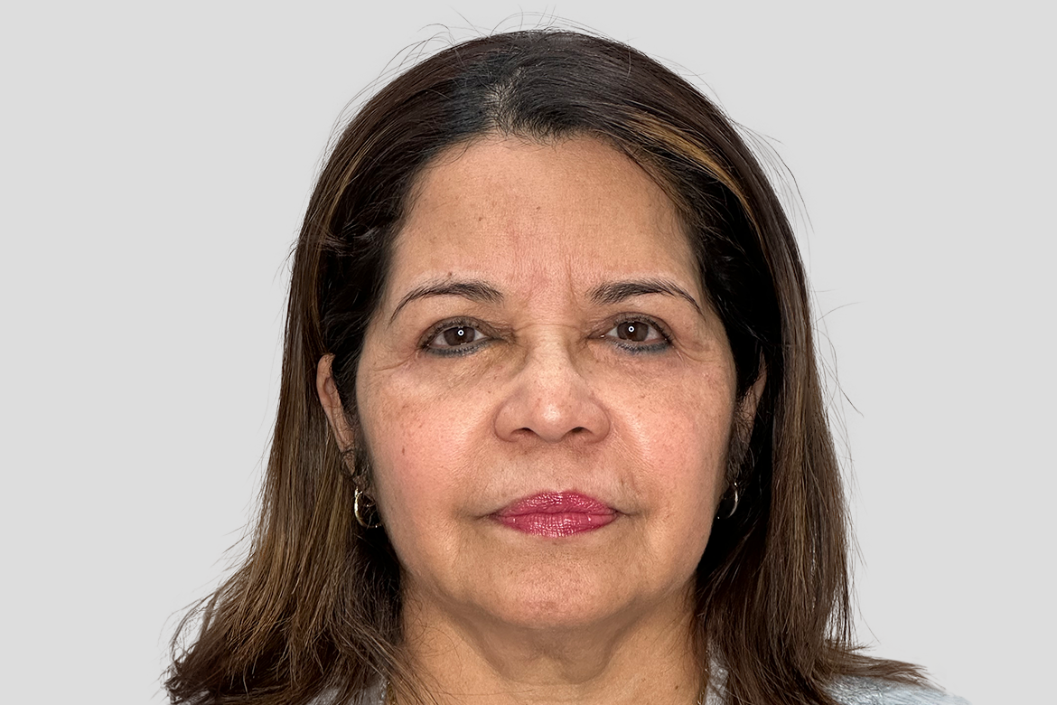 After-BLEFAROPLASTIA SUPERIOR E INFERIOR