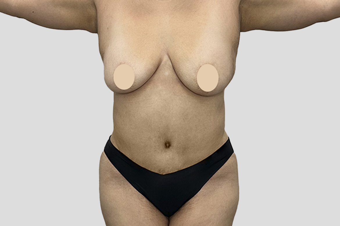 After-LIPOABDOMINOPLASTIA