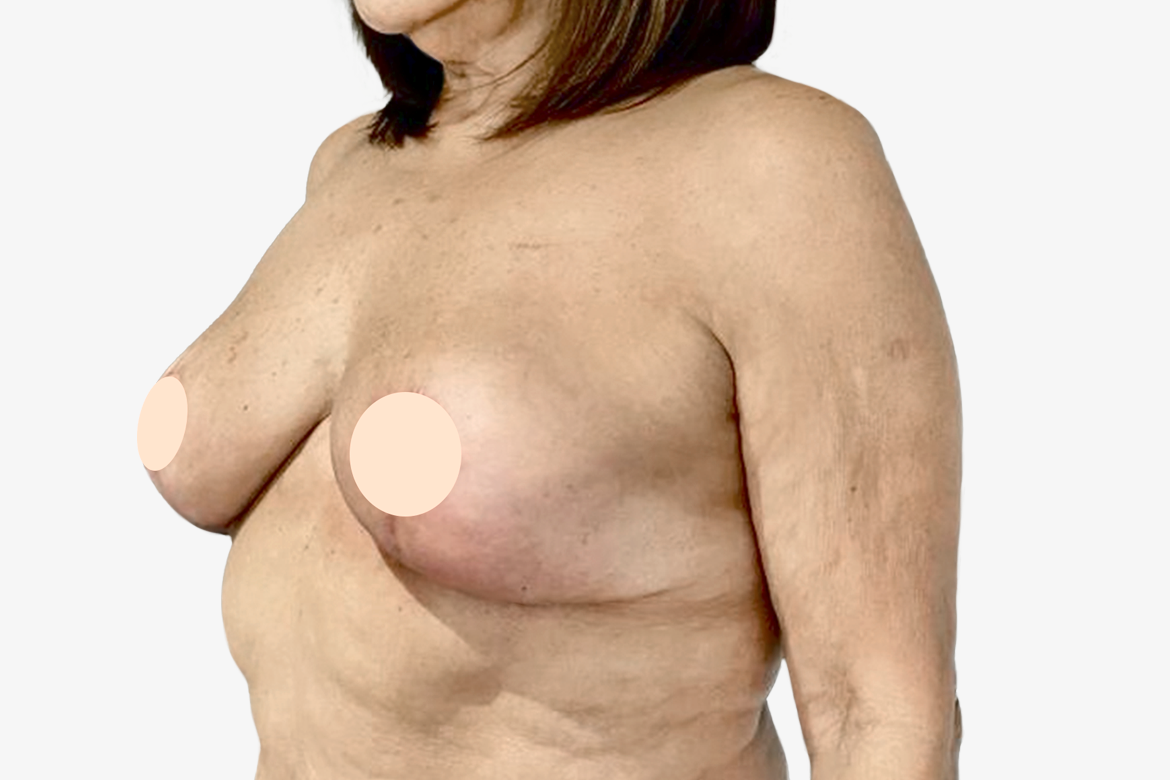 After-EXPLANTACIÓN, LEVANTAMIENTO Y TRANSFERENCIA DE GRASA A LA PARTE SUPERIOR DE LOS SENOS