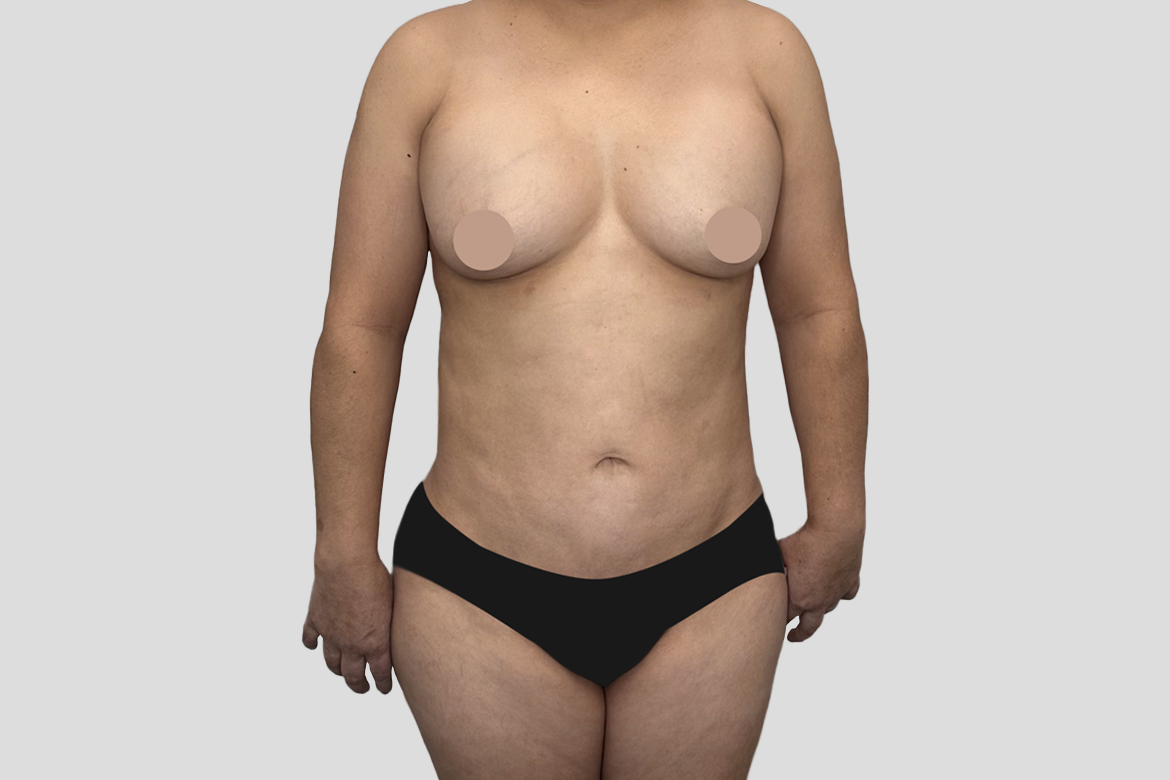 Before-CAMBIO DE IMPLANTES