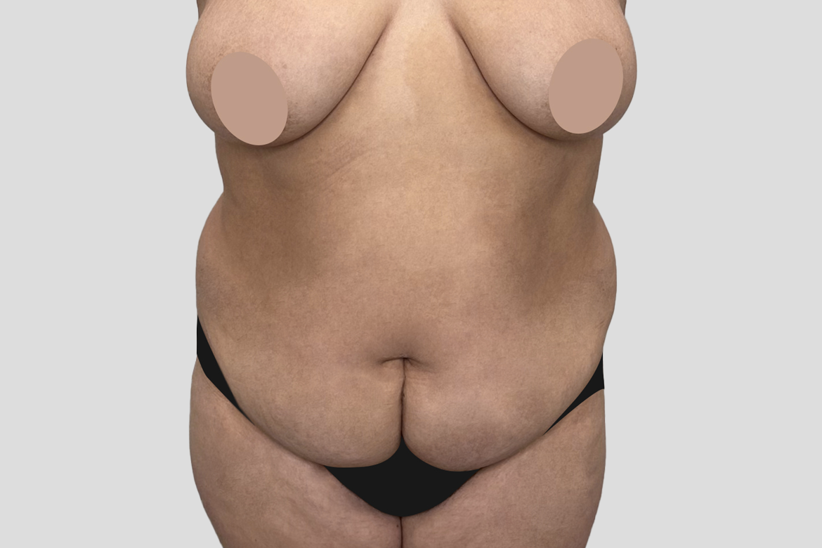 Before-ABDOMINOPLASTIA