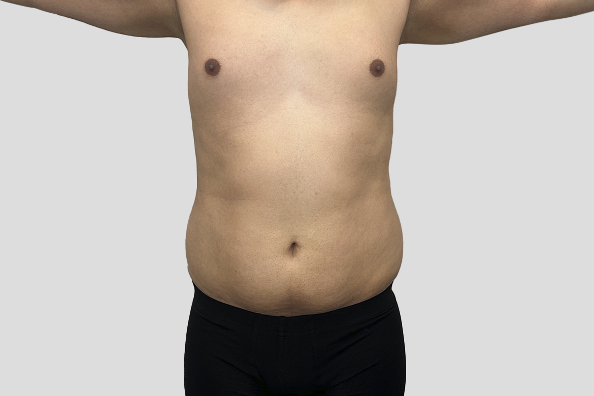Before-GINECOMASTECTOMÍA + LIPOSUCCIÓN DE ABDOMEN Y ESPALDA BAJA