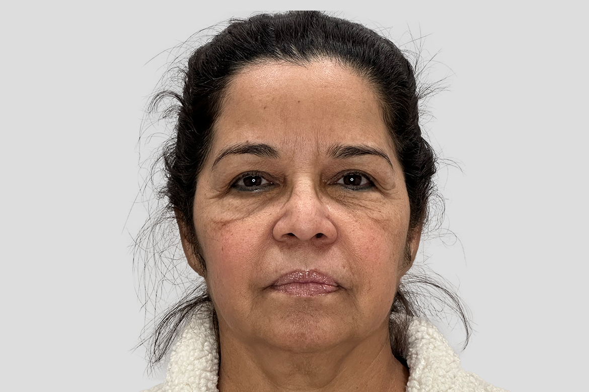 Before-BLEFAROPLASTIA SUPERIOR E INFERIOR