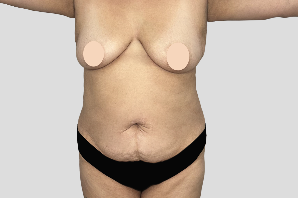 Before-LIPOABDOMINOPLASTIA