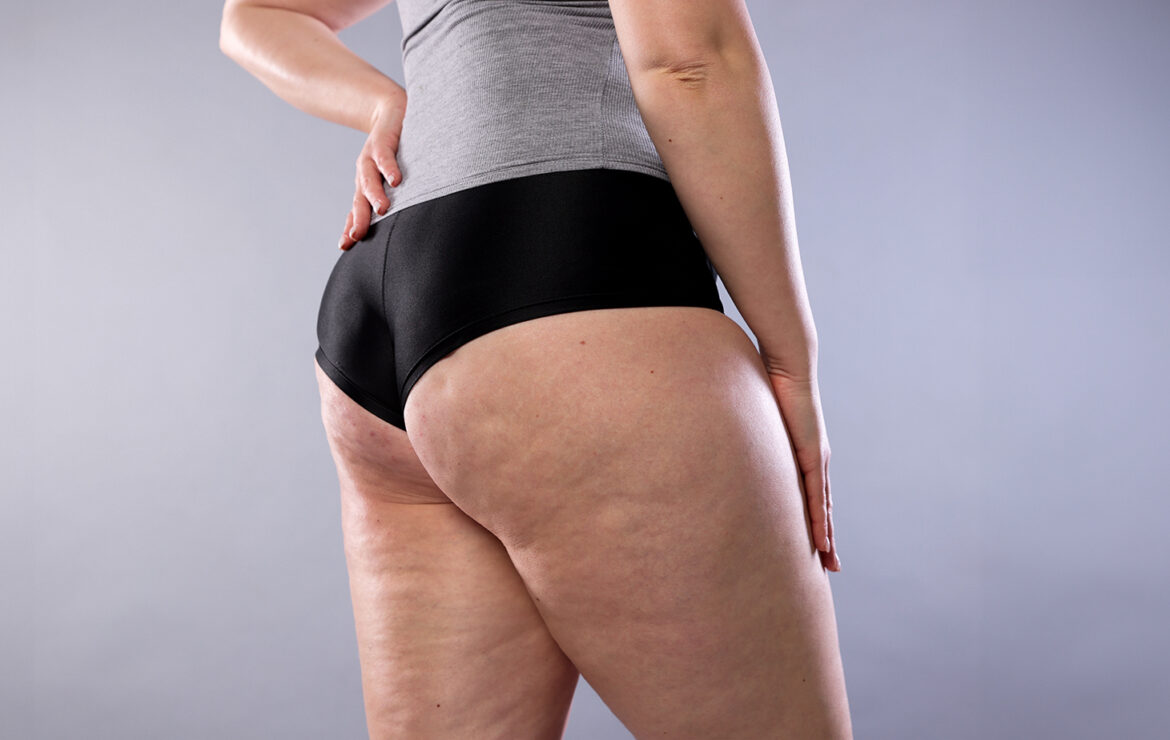 Treatment for cellulite and flaccidity: Avéli