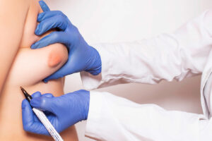 Gynecomastia Surgery in Atlanta