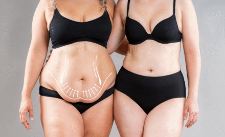 ¿Cuál es el mejor Mommy Makeover?: Una cirugía personalizada