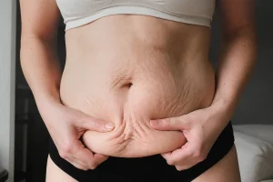 Body contouring: Body reshaping after weight loss